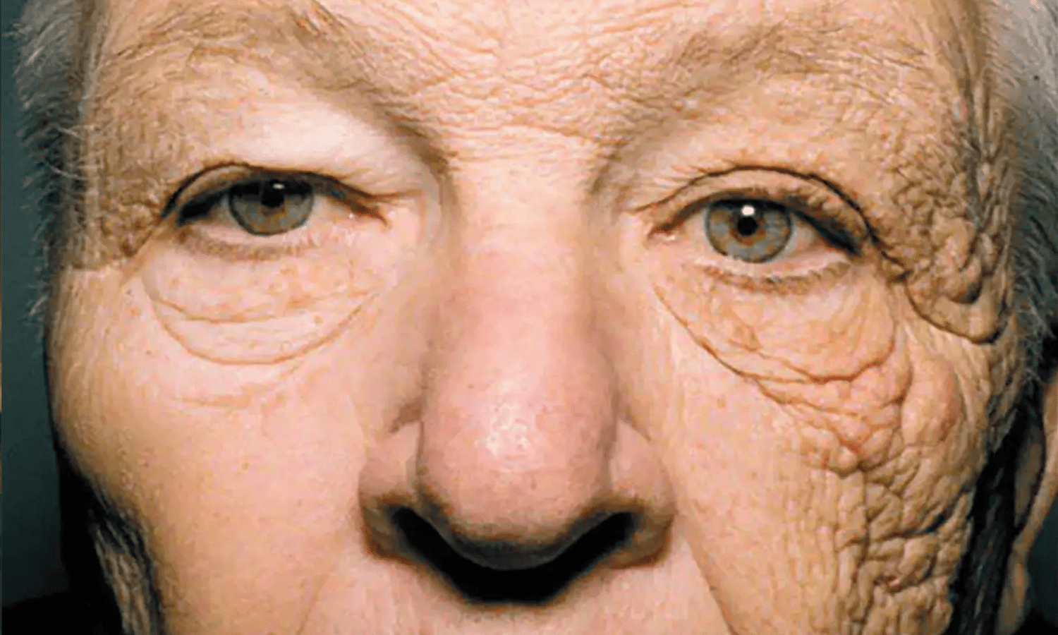 what to do about wrinkles